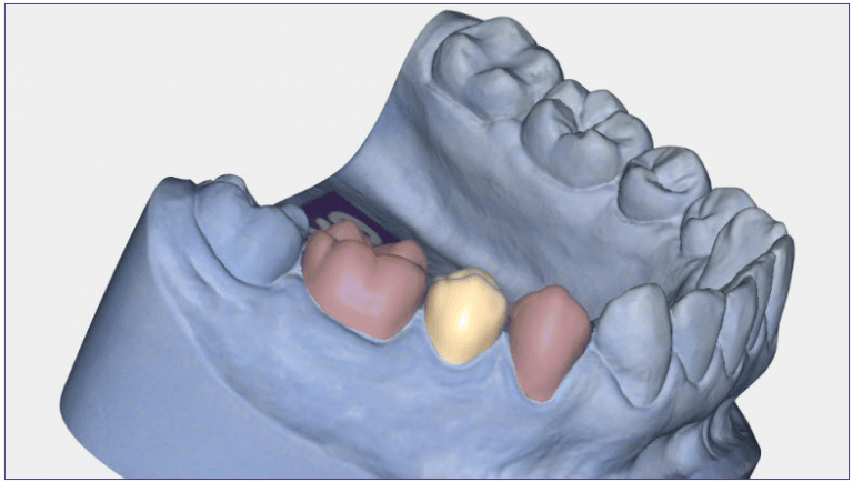 exocad for dentists - Dental CAD Website